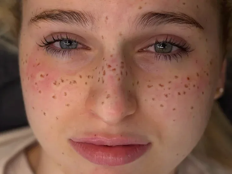 Freckle tattoo — full frontal face portrait of young woman with soft natural freckles